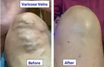  I have varicose veins on my right knee. The results of using the 3in1 terahertz therapy blower on my legs. My bulging varicose veins disappeared, Wow!